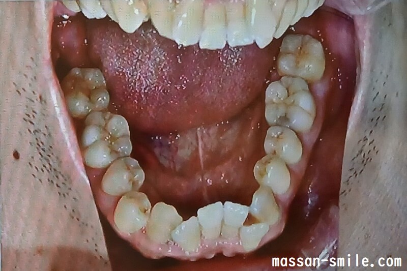 歯列矯正前の歯並び