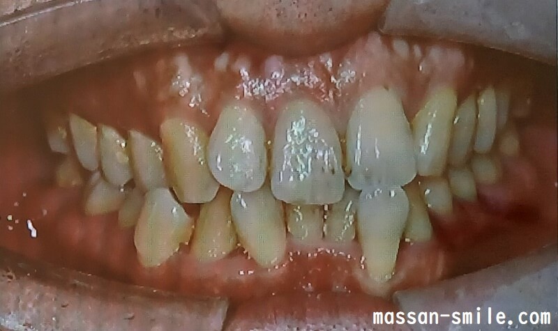 歯列矯正前の歯並び