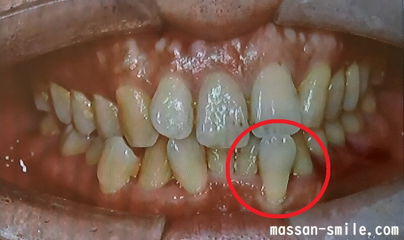 歯並びの悪い前歯