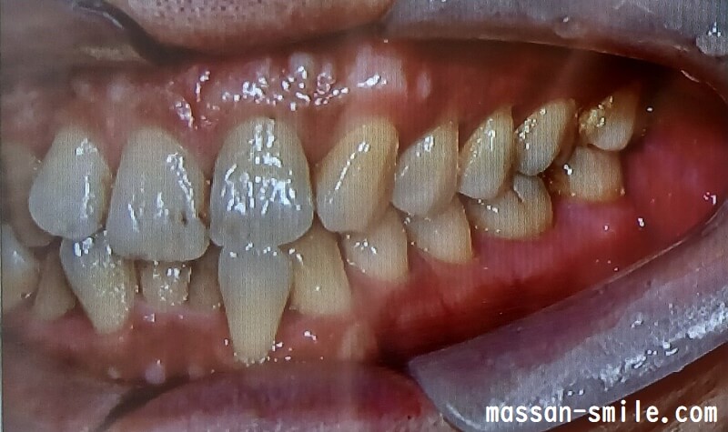 歯列矯正前の歯並び