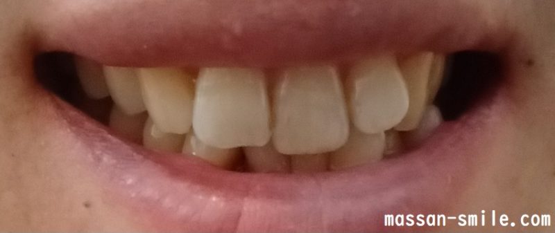 抜歯後の笑顔をつくった口もと