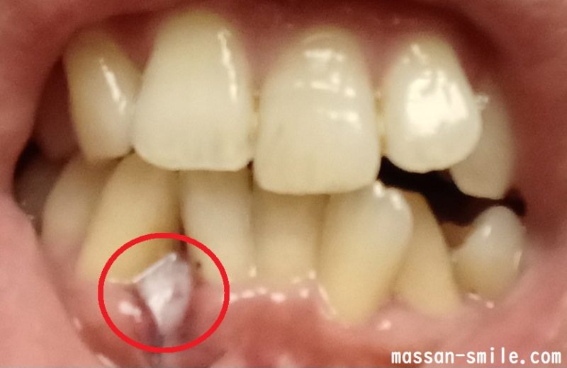 抜歯した場所にあるコラーゲンのスポンジ