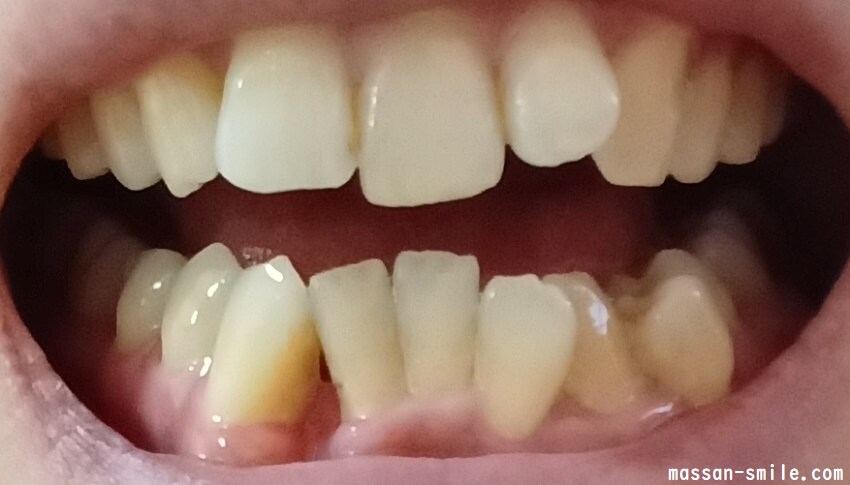 歯列矯正前の歯の画像