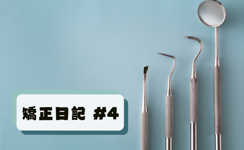 マウスピースで部分矯正をできるかの事前確認のために歯型を取ってきた